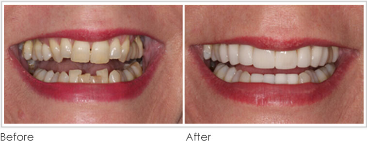 Crooked Teeth - Before After