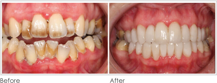 Discoloured Teeth - Before After