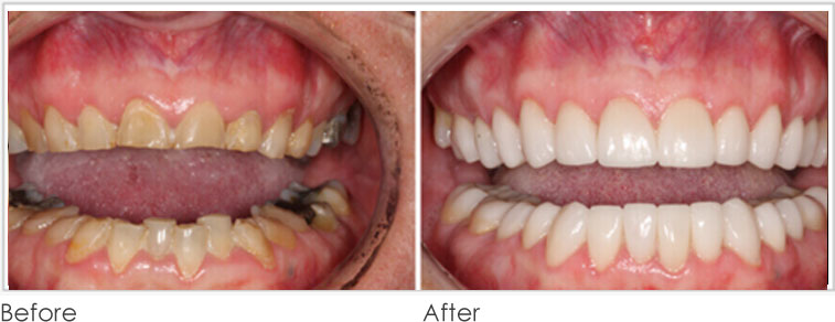 Damaged Teeth - Before After