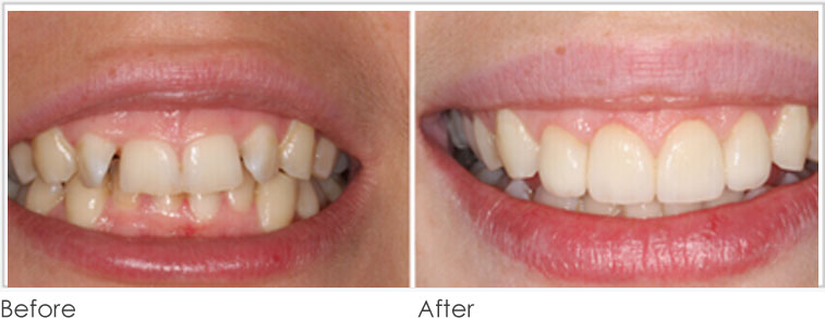 Uneven Gum Line - Before After