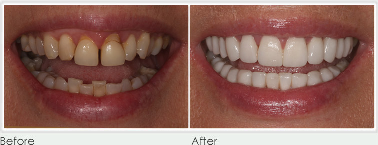 Before & After Veneers Treatment at Perfect Smile Spa