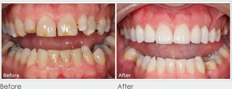 Before & After Veneers Treatment at Perfect Smile Spa
