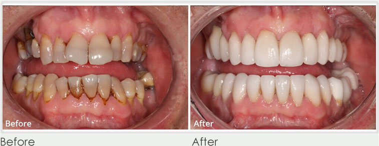 Dental Veneers Before After
