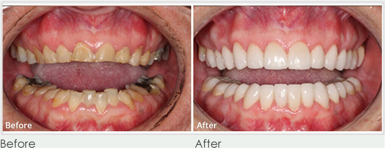 before and after perfect smile spa