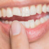 Cracked Tooth: Signs. Symptoms, Prevention & Treatment