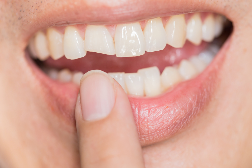 Cracked Tooth: Signs. Symptoms, Prevention & Treatment