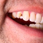 Handling Dental Trauma