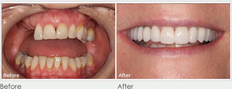 before and after result of f Dental Implants 