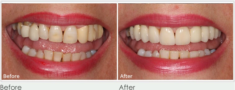 Dental Bridges treatment results