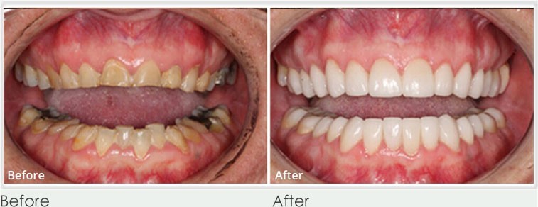 Dental Crowns  before and after result