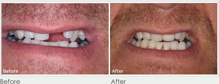 Dental Implants before and after 