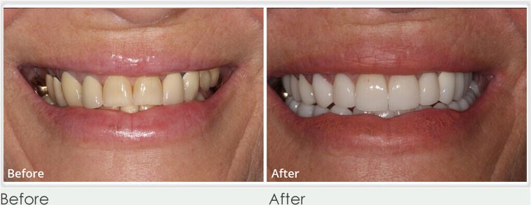 Dental Bridges before and after 