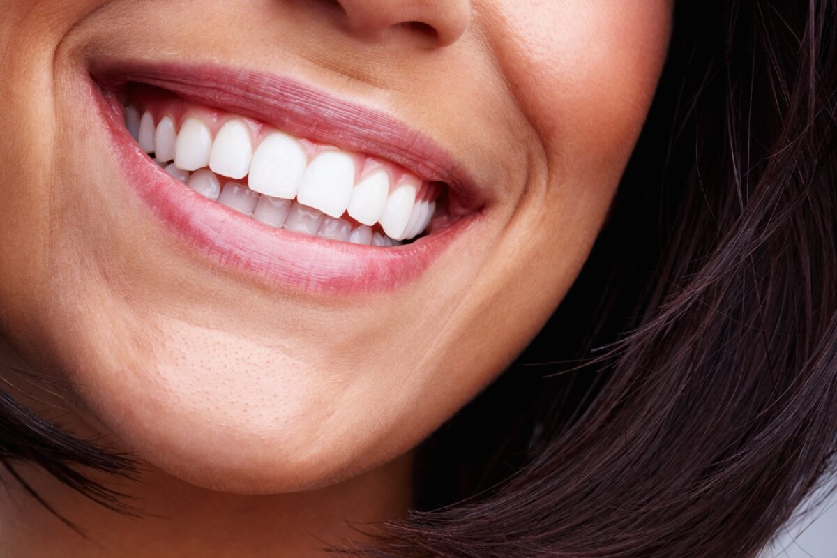 dental veneers Essex