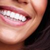 dental veneers Essex