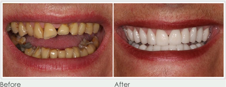 composite veneers Essex