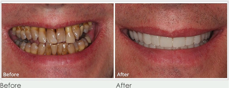 same-day-teeth-implants-before