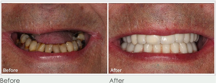 same-day-teeth-implants-before-after