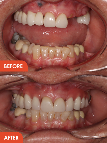 cosmetic dentures essex treatment before after