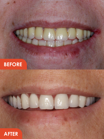 Dental Implants Before After