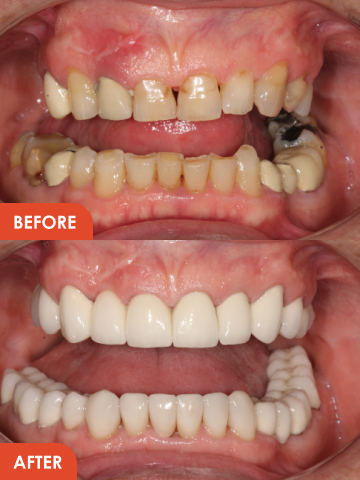 Dental Implants Essex Result