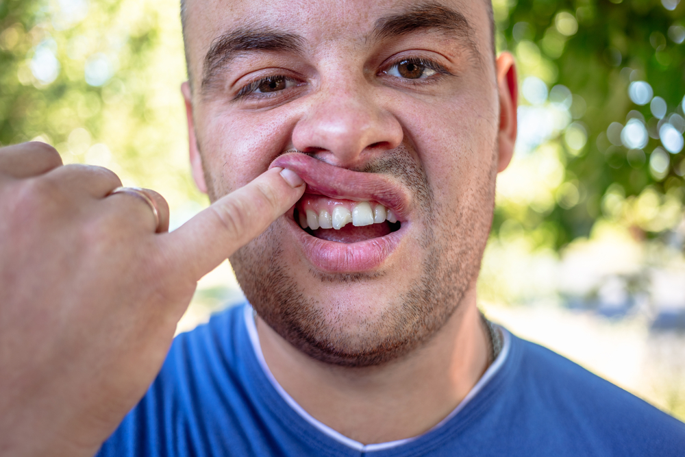 Dental veneers Treatment