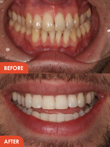 veneers before and after in Essex