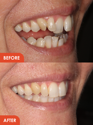 Inman Aligner Essex Treatment result