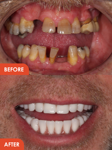 cosmetic dentures essex treatment result