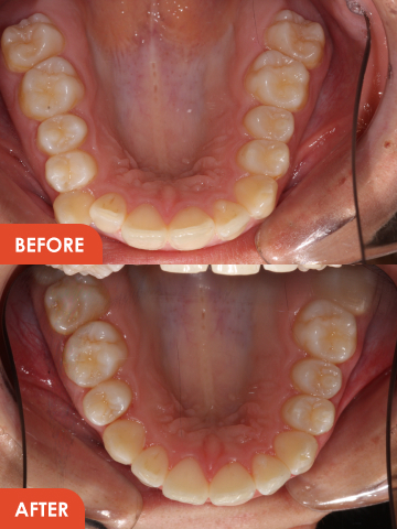 Clear Aligners Result