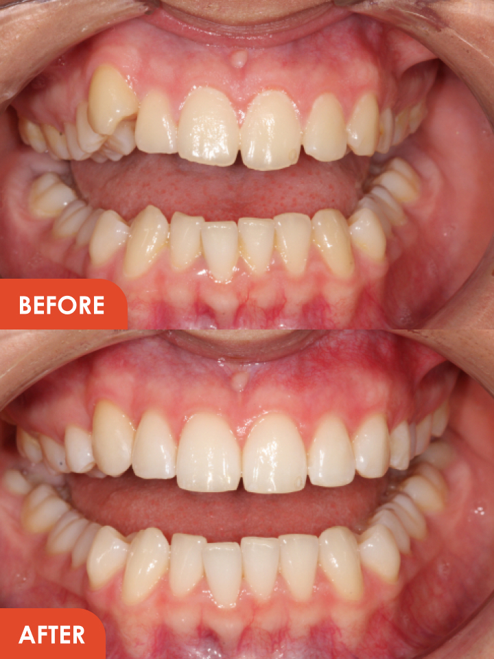 Inman Aligner Essex Treatment before after