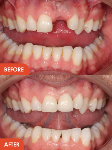 Dental Implants Essex Before After