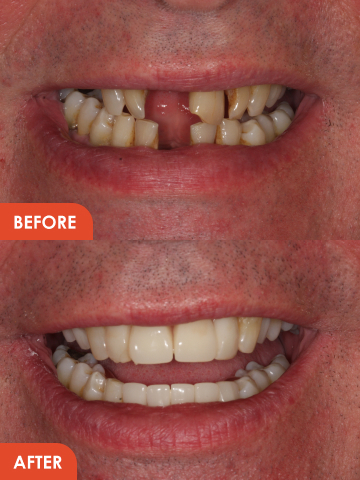 cosmetic dentures essex treatment