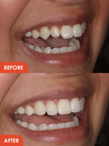 composite dental veneers in Essex before and after