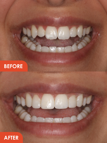 veneers dentist in Essex before and after results