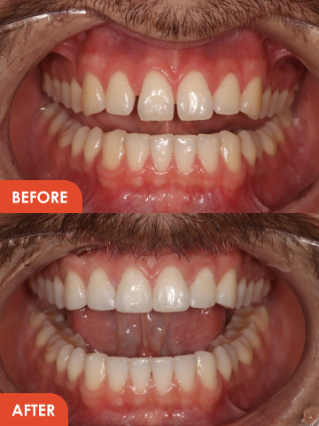 dental veneers before and after treatment Essex