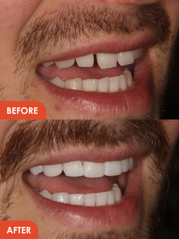 Essex dental venners before and after