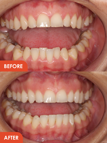 Inman Aligner Essex Treatment result