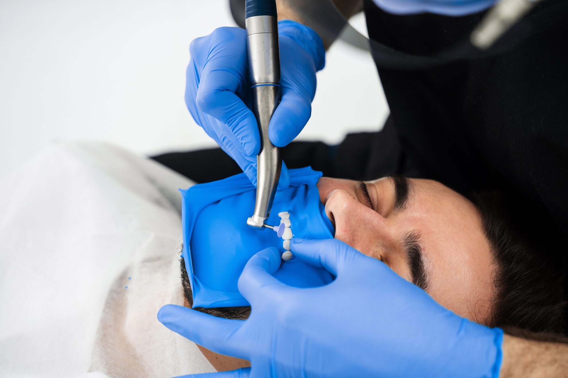 Are Veneers Painful? The Truth About Veneers Pain Management