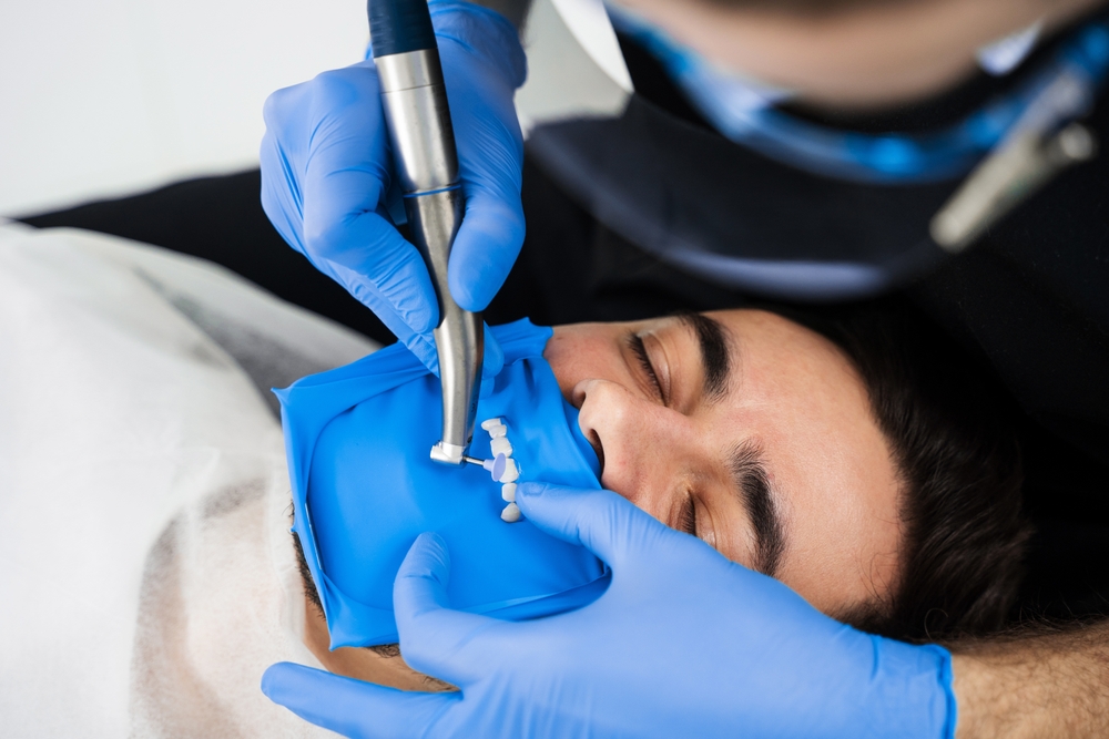 Dental veneers installing preparation