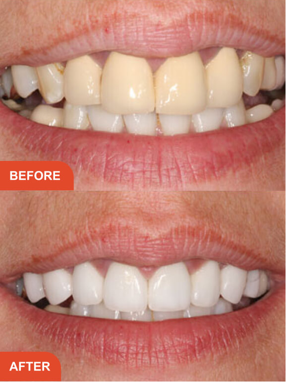 Dental Implants Essex treatment result