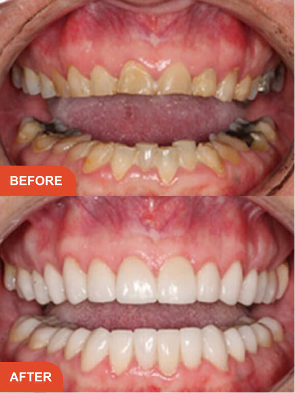 Dental Implants Essex treatment result