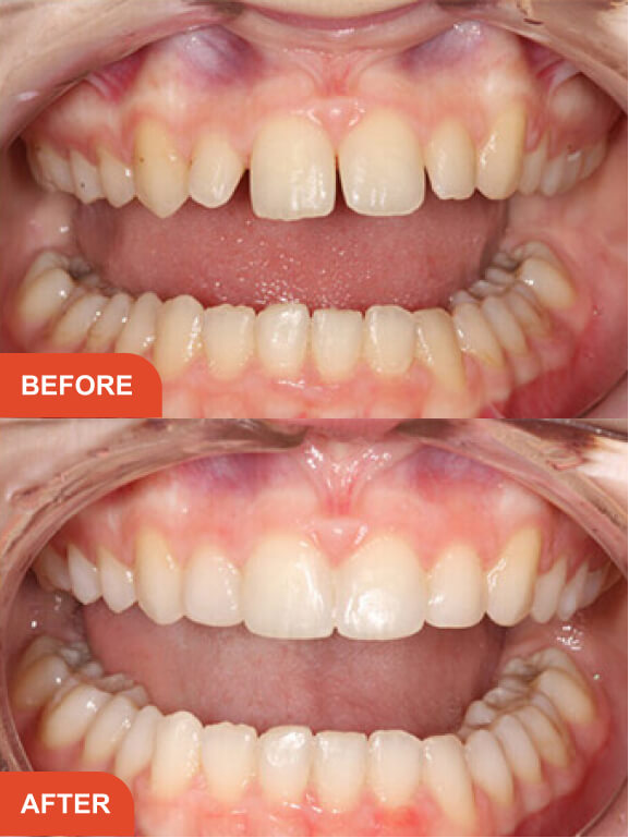 Dental Implants Essex treatment result