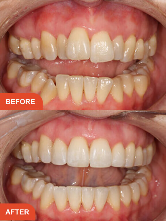 Dental Implants Essex treatment result