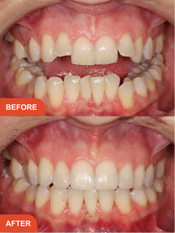 Dental Implants Essex treatment result