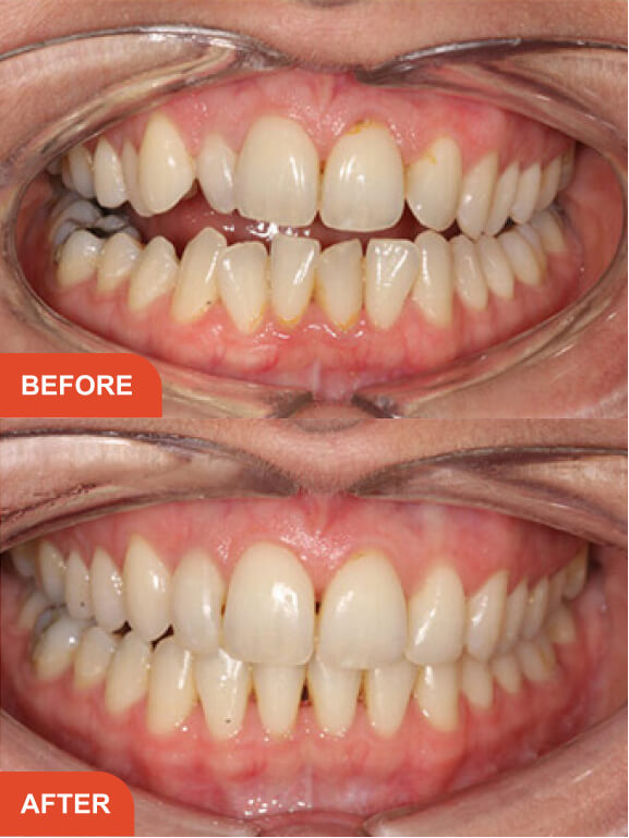 Dental Implants Essex treatment result