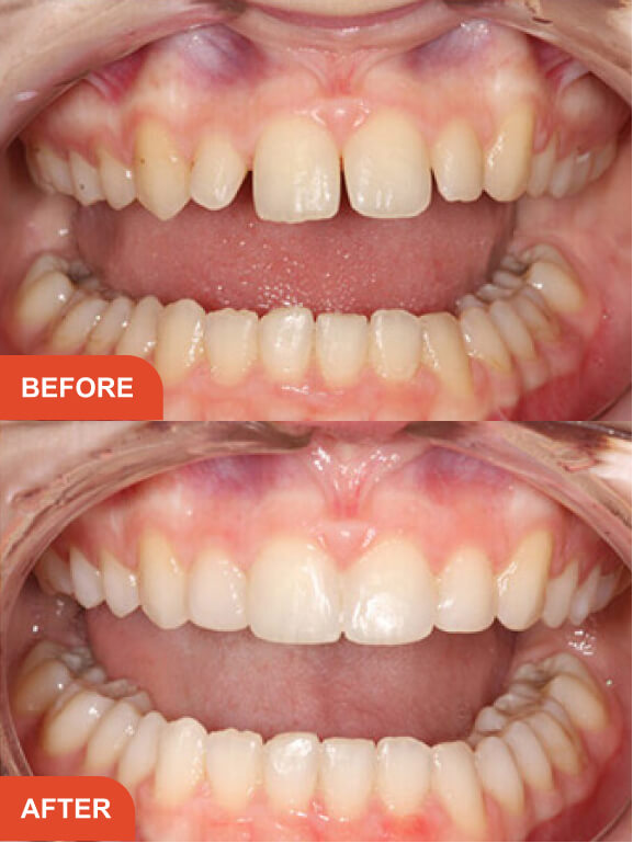 Dental Implants Essex treatment result