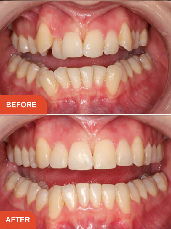 Dental Implants Essex treatment result