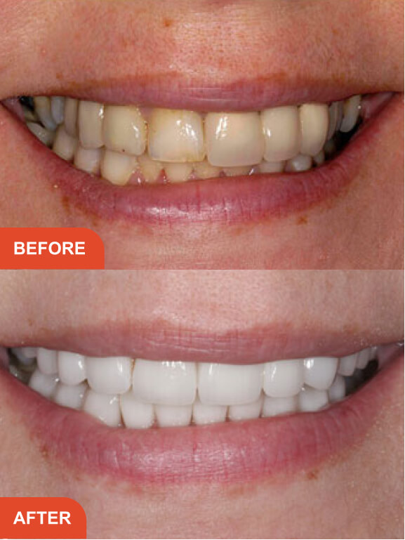 Dental Implants Essex treatment result