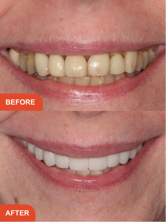 Dental Implants Essex treatment result