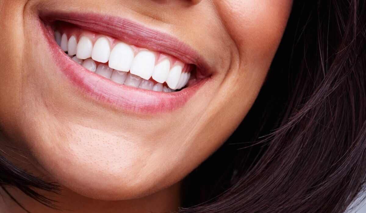 colour mismatch veneers